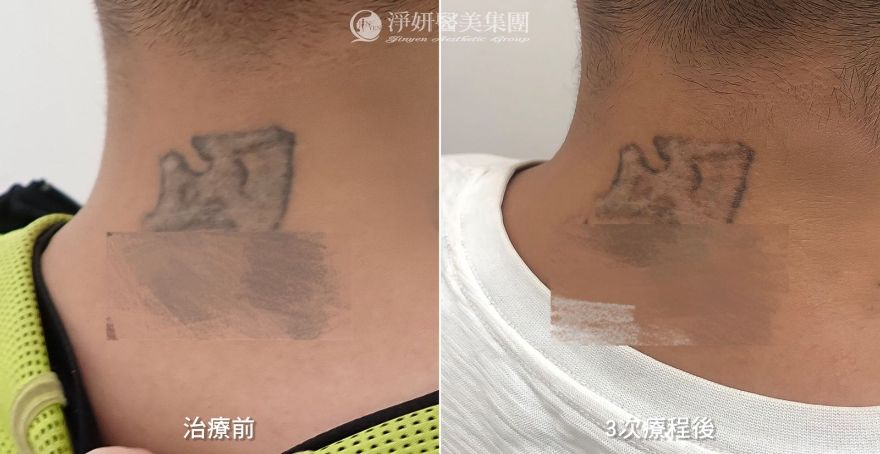 《淨妍公益皮秒除刺青》 退去過往的印記 重啟人生的勇氣