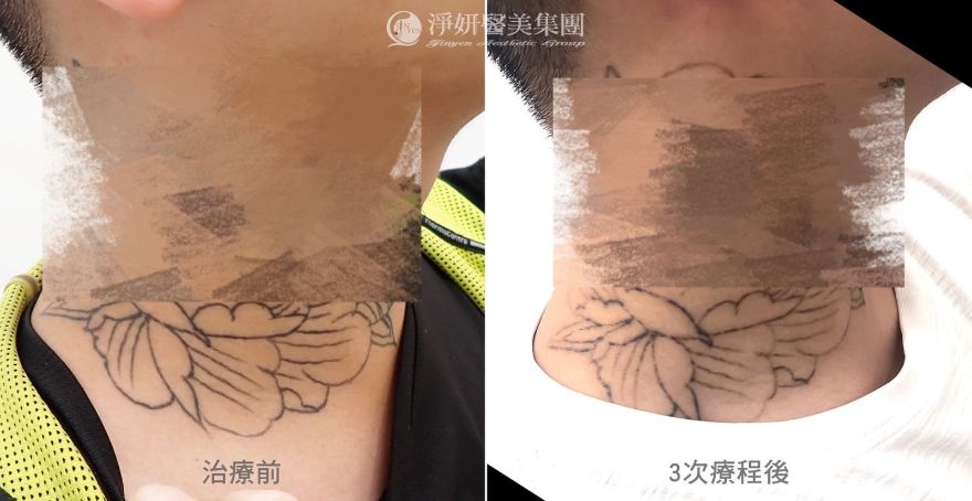 《淨妍公益皮秒除刺青》 退去過往的印記 重啟人生的勇氣