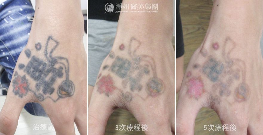 淨妍醫美皮秒雷射除刺青