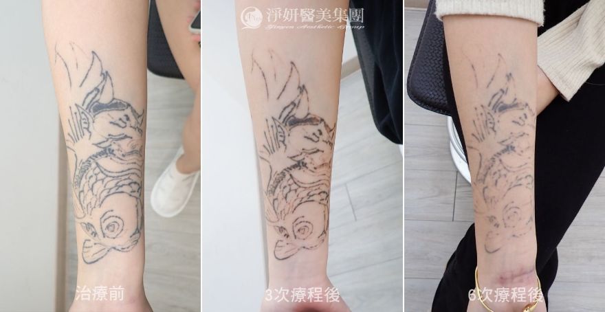 淨妍醫美公益除刺青