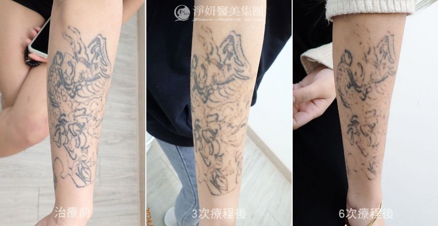 淨妍醫美公益除刺青