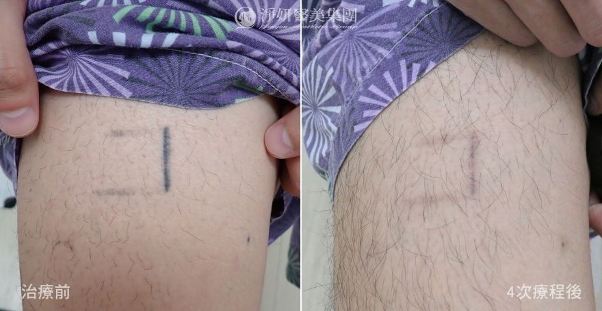 淨妍醫美公益除刺青