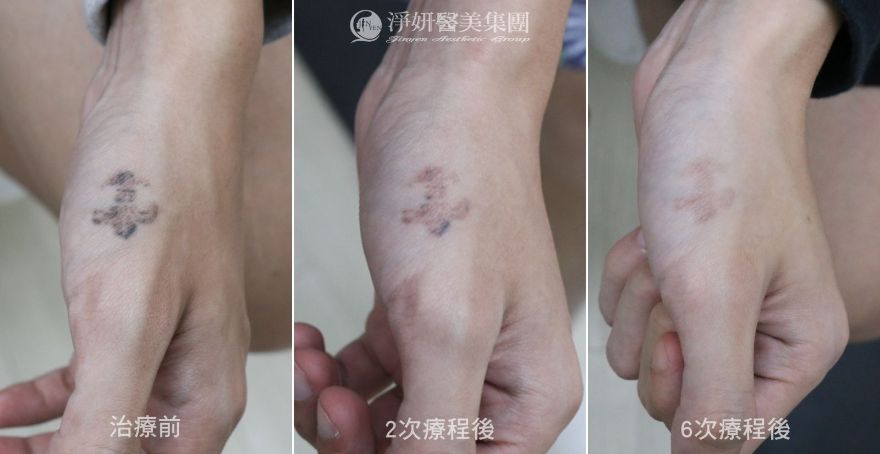 淨妍醫美公益除刺青