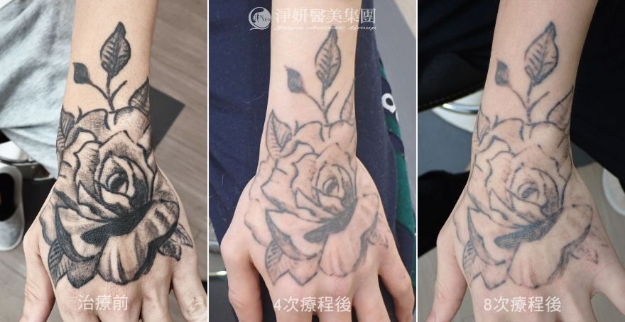 《淨妍公益除刺青》刺青會消失 但成長留下