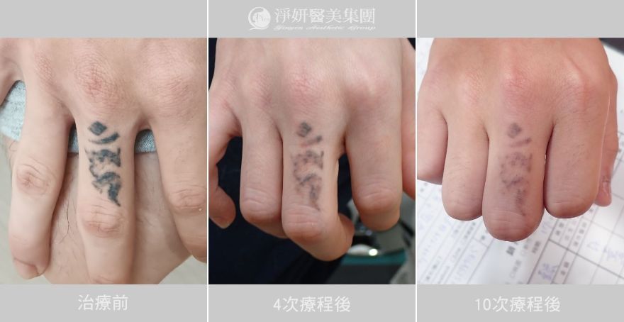 《淨妍公益除刺青》刺青會消失 但成長留下