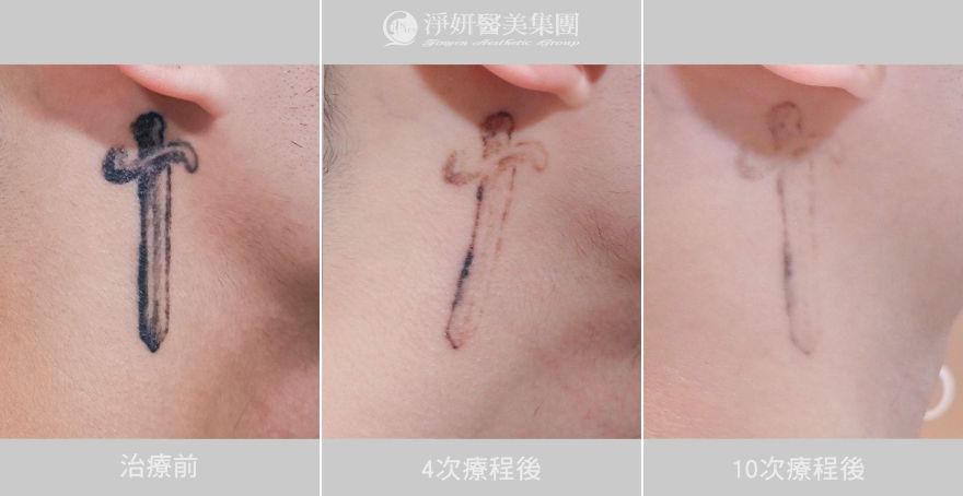 《淨妍公益除刺青》刺青會消失 但成長留下