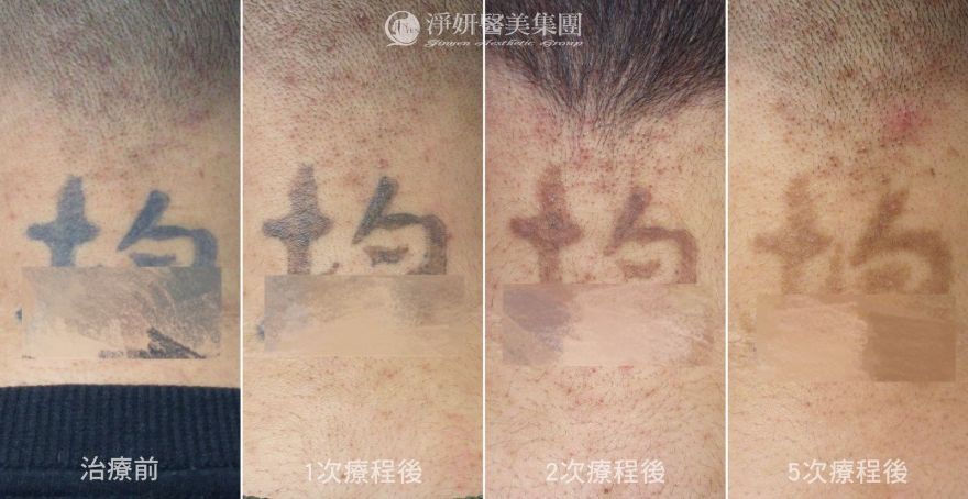 公益除刺青 年少衝動留下印記 19歲青年重整人生