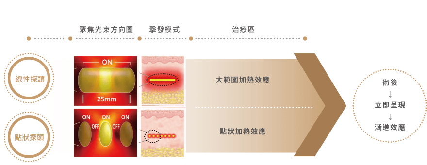 Q+立線音波線性探頭利用線性輸出的音波，達到大範圍的加熱刺激，在安全的58°C加熱溫度下，達到脂肪組織的改善