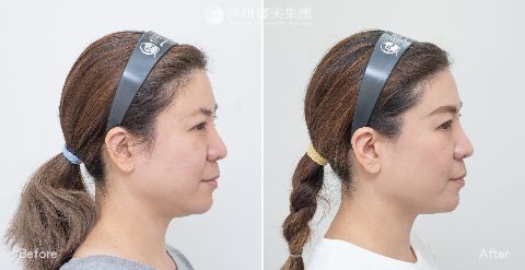 淨妍醫美海芙電波真實案例分享
