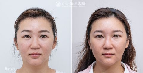 淨妍醫美海芙電波真實案例分享