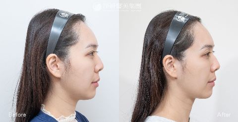 淨妍醫美海芙電波1200發真實案例分享