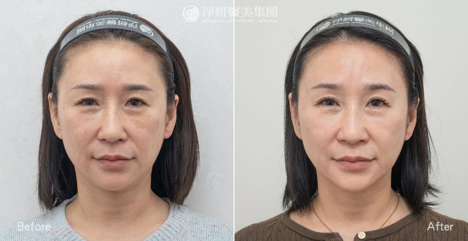 全臉&脖子_音波300條&電波800發_劉康瑩醫師