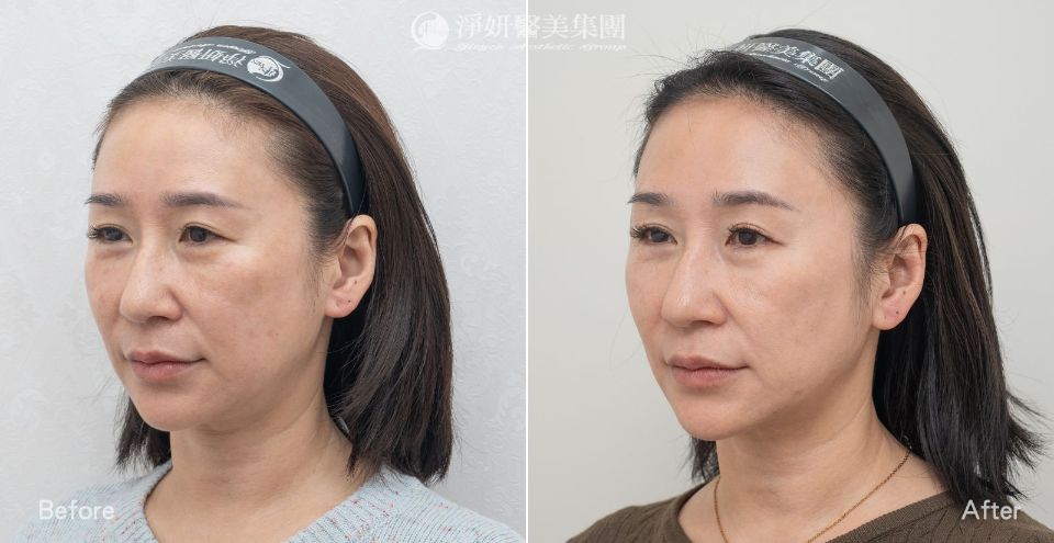 全臉&脖子_音波300條&電波800發_劉康瑩醫師