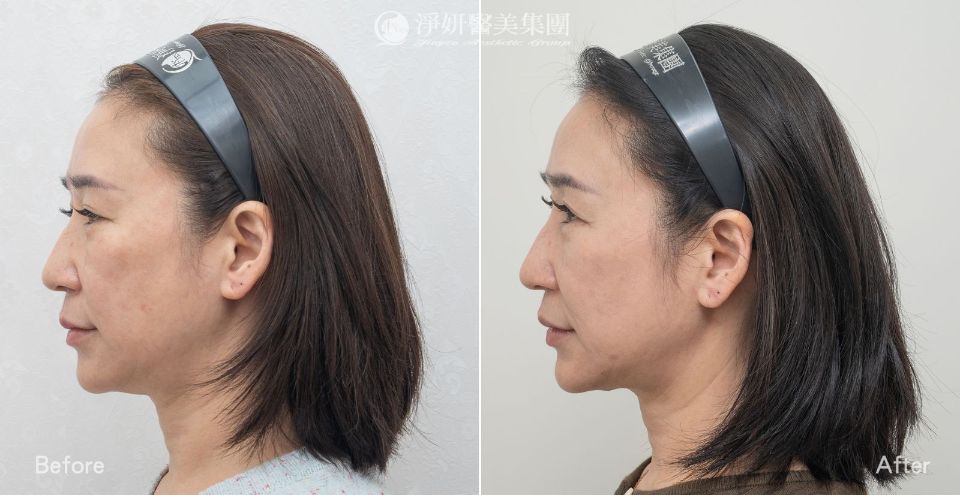 全臉&脖子_音波300條&電波800發_劉康瑩醫師