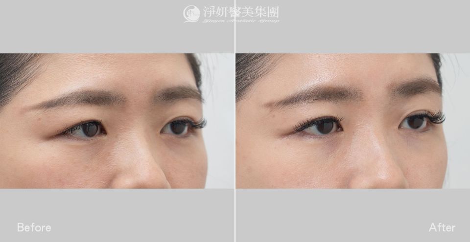 眼周_音波300條&電波400發_劉康瑩醫師