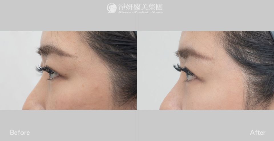 眼周_音波300條&電波400發_劉康瑩醫師