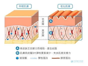 喬雅登玻尿酸、瑞絲朗玻尿酸，大小分子、適合部位、維持時間，妳想知道的都在這裡