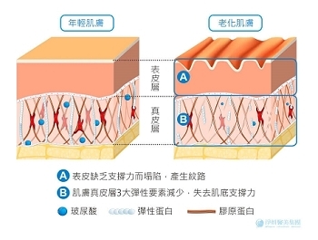 喬雅登玻尿酸、瑞絲朗玻尿酸，大小分子、適合部位、維持時間，妳想知道的都在這裡