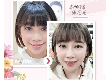 音波拉提最新懶人包》效果、費用、會痛嗎、和電波的差別