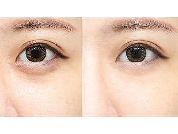 消除黑眼圈懶人包》醫生教你分辨黑眼圈類型及治療方法