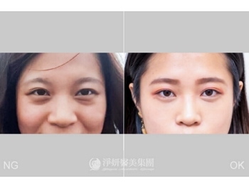 你是哪種黑眼圈種類？ 黑眼圈形成原因？對症下藥有效去除黑眼圈！
