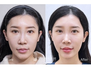 薇貝拉dcard ptt討論度高 膠原蛋白增生效果真的好嗎？