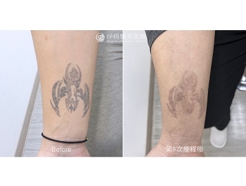 淨妍助消除印記 解開少心靈束縛