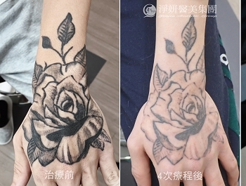 《淨妍公益除刺青》刺青會消失 但成長留下