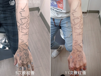 淨妍醫美公益助力　助年輕父親去除印記