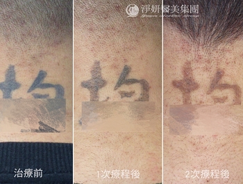 年少衝動留下印記　19歲青年重整人生