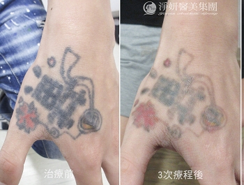 刺過、後悔過，最後選擇留下空白 為雙手留下另一種乾淨