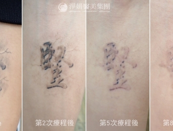 《淨妍公益除刺青》從年少印記到重新理解愛 少年以行動回應母親牽掛
