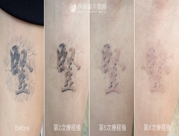 《淨妍社會公益》雷射下的成長印記：卸下年少衝動，專心迎戰大學考試