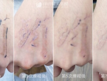 《淨妍社會公益》雷射下的成長印記：卸下年少衝動，專心迎戰大學考試