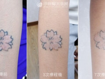《淨妍公益除刺青》不只是除刺青 更望少重新看見未來